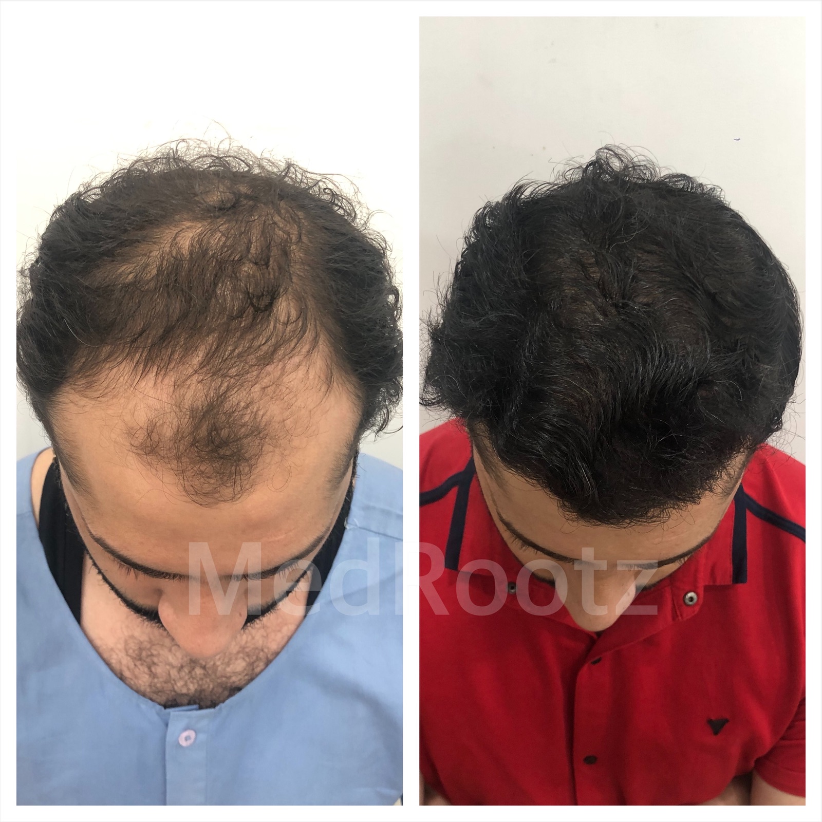 Best Hair Transplant clinic in delhi